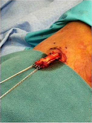 Distal Biceps Tendon with Endobutton